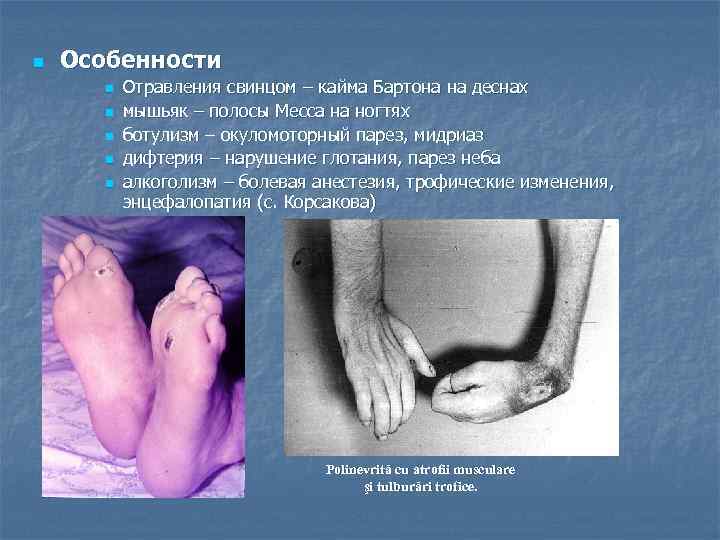 n Особенности n n n Отравления свинцом – кайма Бартона на деснах мышьяк –