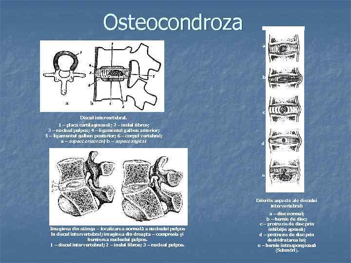 Osteocondroza a b Discul intervertebral. 1 – placa cartilaginoasă; 2 – inelul fibros; 3