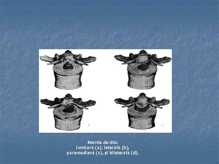 a b c d Hernie de disc lombară (a), laterală (b), paramediană (c), şi