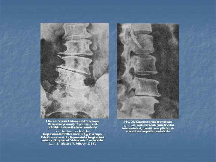 FIG. 25. Scolioză lateralizată în stânga. Reducerea pronunţată şi neuniformă a înălţimii discurilor intervertebrale