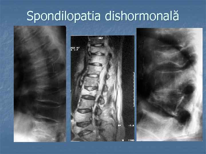 Spondilopatia dishormonală 
