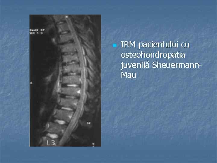 n IRM pacientului cu osteohondropatia juvenilă Sheuermann. Mau 