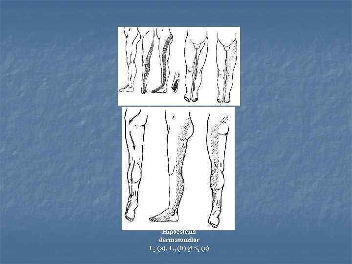 a b c Hipoestezia dermatomilor L 5 (a), L 4 (b) şi S 1