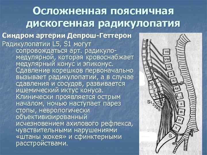 Осложненная поясничная дискогенная радикулопатия Синдром артерии Депрош-Геттерон Радикулопатии L 5, S 1 могут сопровождаться