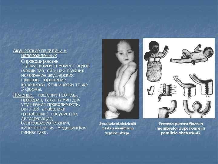 Акушерские параличи у новорожденных Спровоцированы травматизмом в момент родов (узкий таз, сильная тракция, наложение