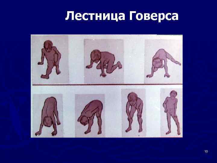 Лестница Говерса 10 