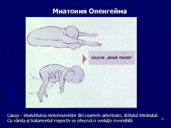 Миатония Опенгейма Cauza – imaturitatea motoneuronilor din coarnele anterioare, debutul intranatal. Cu vârsta şi