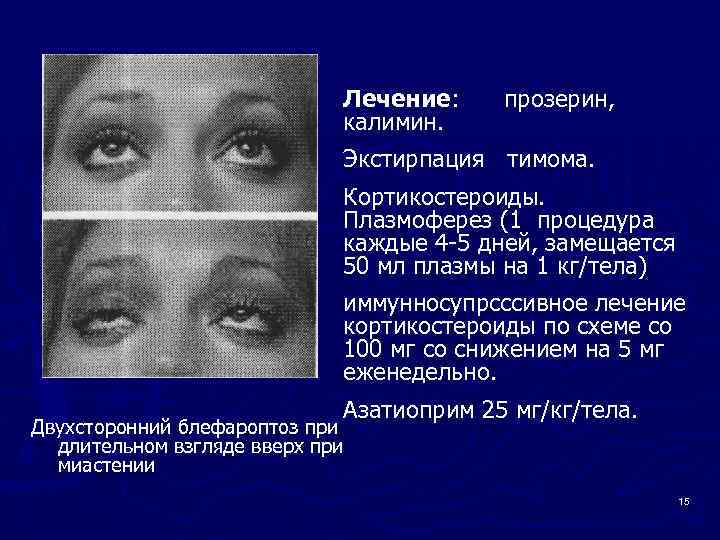 Лечение: калимин. прозерин, Экстирпация тимома. Кортикостероиды. Плазмоферез (1 процедура каждые 4 -5 дней, замещается