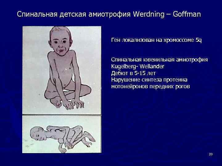 Спинальная амиотрофия презентация