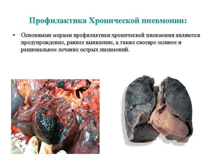 Профилактика Хронической пневмонии: • Основными мерами профилактики хронической пневмонии являются предупреждение, раннее выявление, а