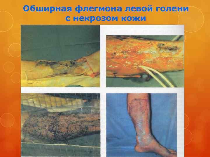 Обширная флегмона левой голени с некрозом кожи 