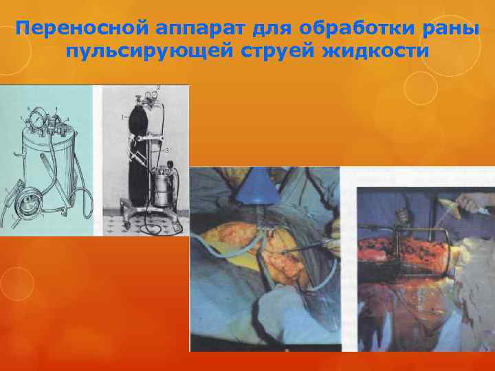 Переносной аппарат для обработки раны пульсирующей струей жидкости 