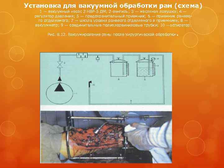 Установка для вакуумной обработки ран (схема) 1 — вакуумный насос 2 НВР-5 ДМ; 2