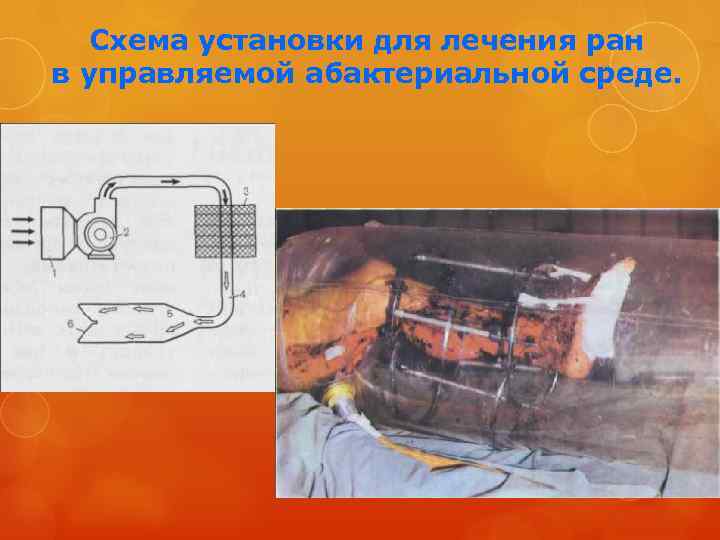 Схема установки для лечения ран в управляемой абактериальной среде. 