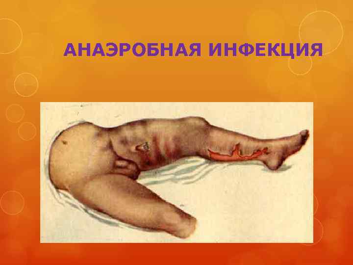  АНАЭРОБНАЯ ИНФЕКЦИЯ 
