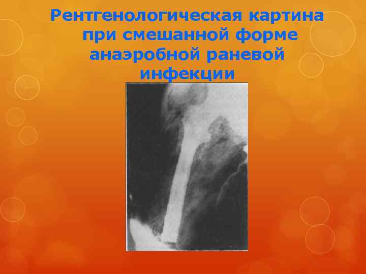 Рентгенологическая картина при смешанной форме анаэробной раневой инфекции 
