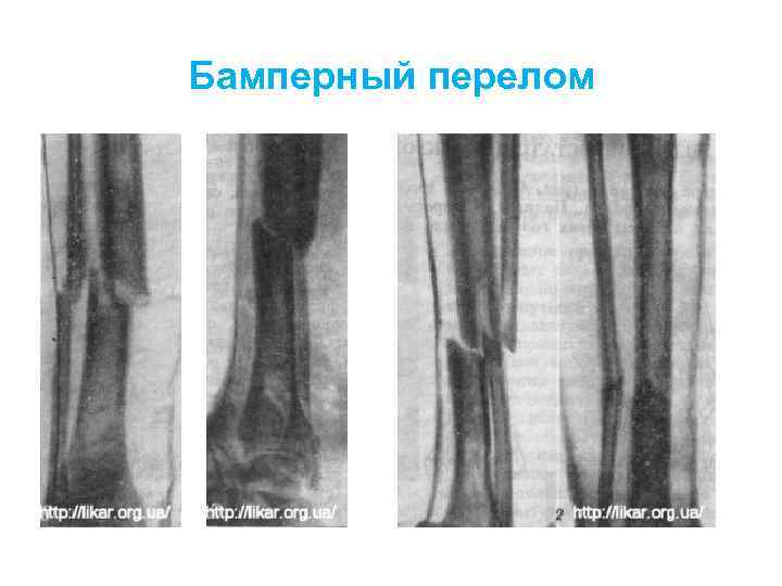 Повреждения голени презентация травматология