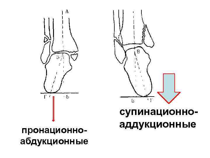 Перелом наружной лодыжки рисунок