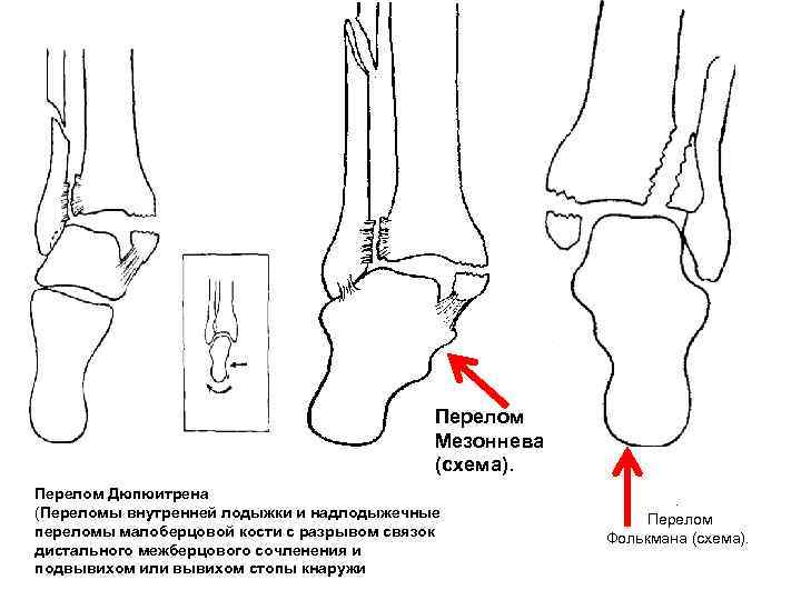 Переломы голеностопа презентация