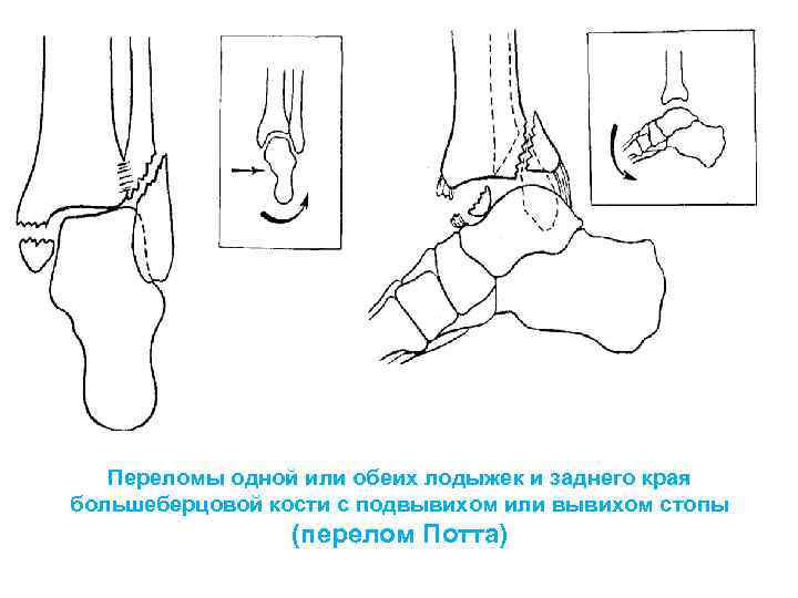 Перелом голеностопа карта вызова