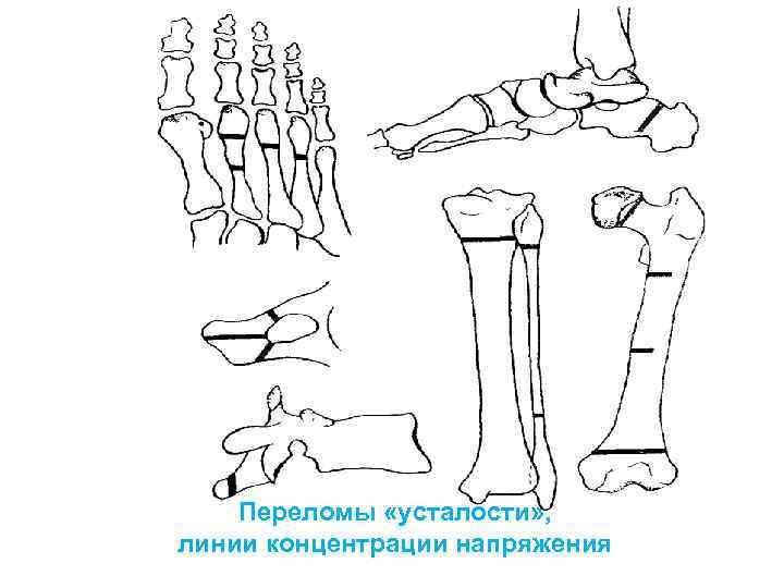 Повреждения голени презентация травматология