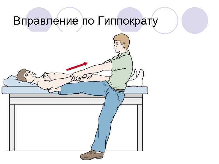 Вправление по Гиппократу 