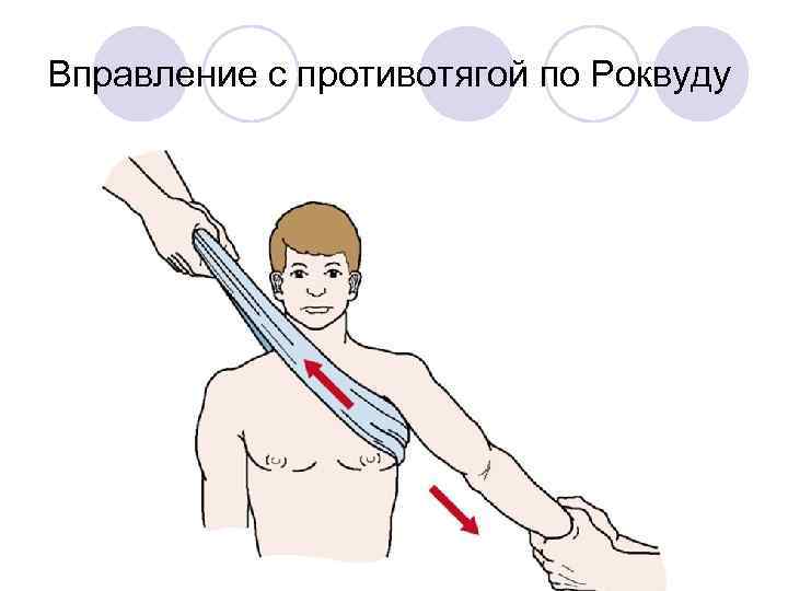 Вправление с противотягой по Роквуду 