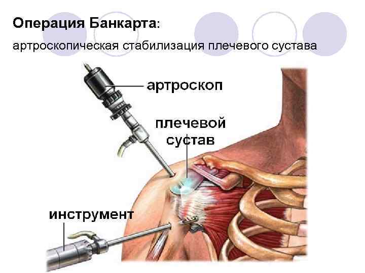 Абстракция на плече