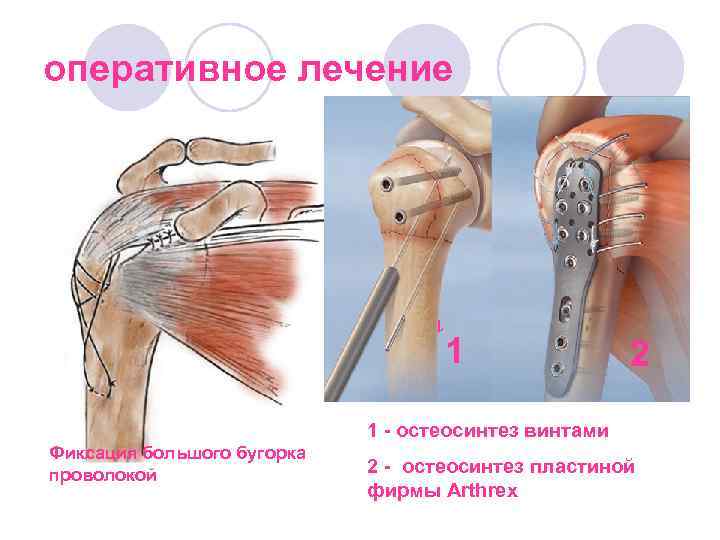 Перелом бугорка плечевой кости. Остеосинтез бугорка плечевой кости. Перелом бугра плечевой кости.