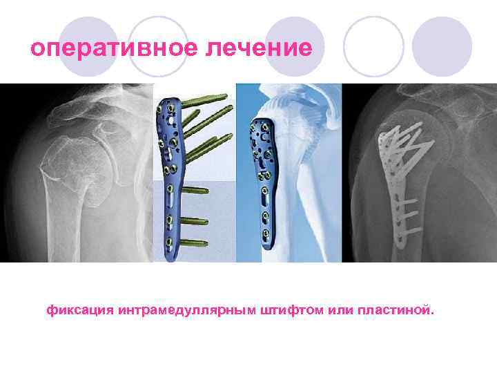 оперативное лечение фиксация интрамедуллярным штифтом или пластиной. 