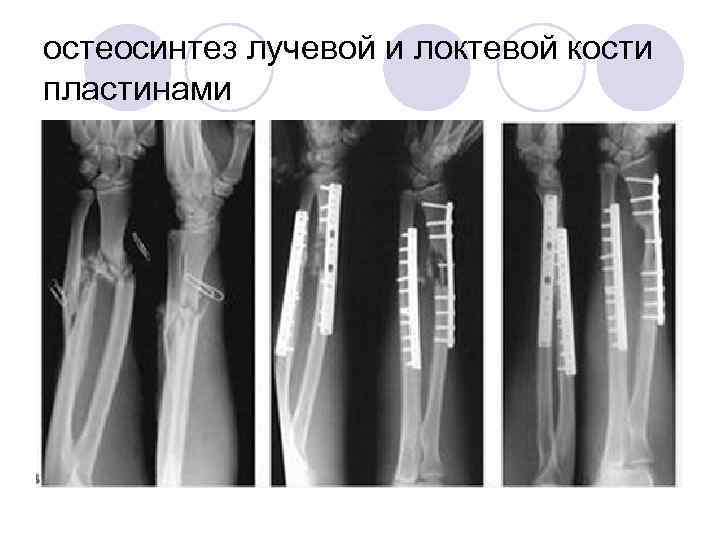 остеосинтез лучевой и локтевой кости пластинами 