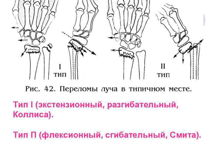 Переломы верхних конечностей. Типичные места переломов костей верхних конечностей. Места переломов верхних конечностей схема. Схематическое изображение мест переломов конечностей. Типичные переломы для костей верхней конечности.