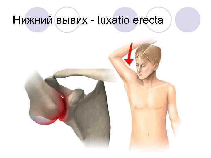Нижний вывих - luxatio erecta 