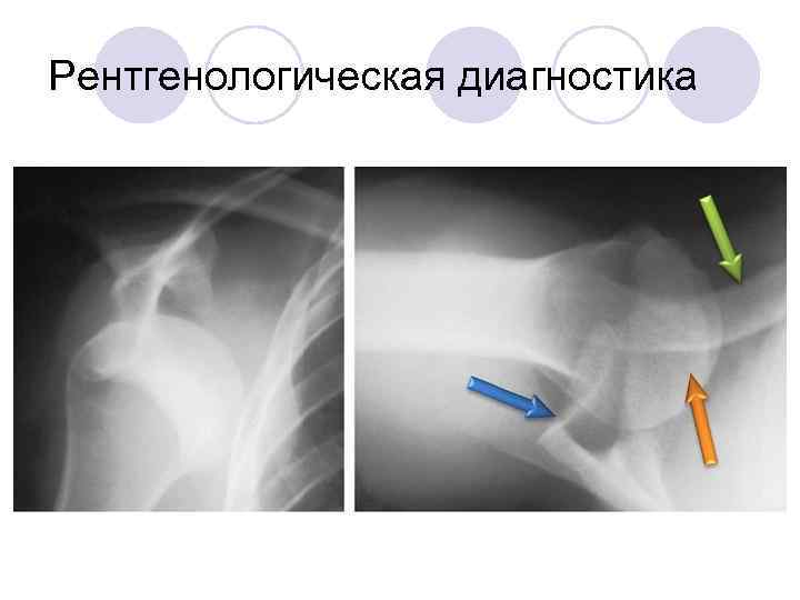 Разрыв лопатки. Рентгеновский снимок плечевого сустава подвывих. Плечевая кость в 2 проекциях. Снимки плечевого сустава в боковой проекции.