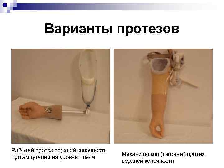 Варианты протезов Рабочий протез верхней конечности при ампутации на уровне плеча Механический (тяговый) протез