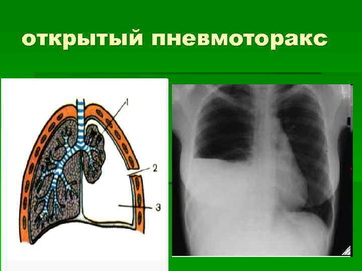 открытый пневмоторакс 