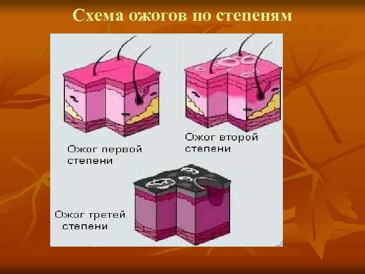 Виды ожогов схема