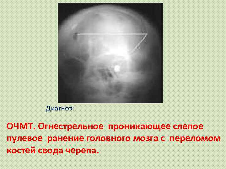 Диагноз: ОЧМТ. Огнестрельное проникающее слепое пулевое ранение головного мозга с переломом костей свода черепа.