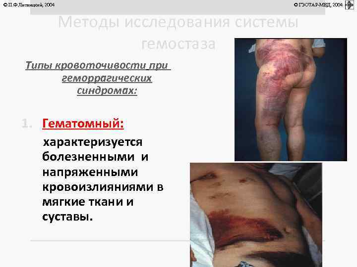© П. Ф. Литвицкий, 2004 © ГЭОТАР-МЕД, 2004 Методы исследования системы гемостаза Типы кровоточивости