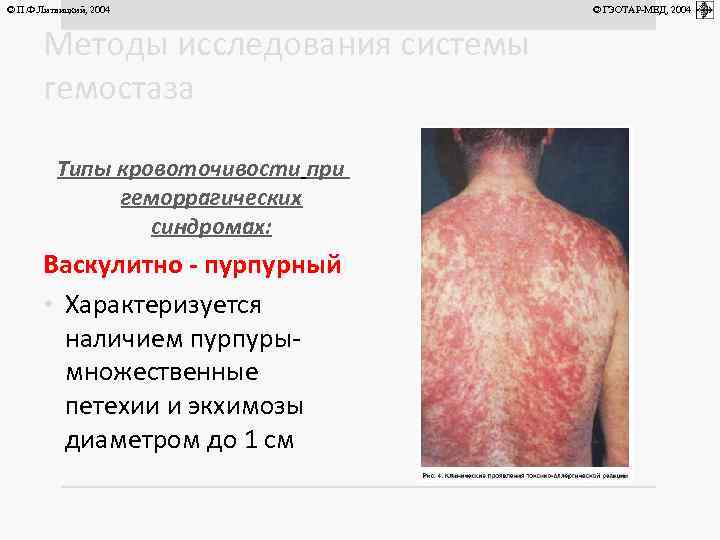 © П. Ф. Литвицкий, 2004 Методы исследования системы гемостаза Типы кровоточивости при геморрагических синдромах: