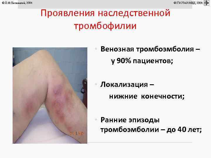 © П. Ф. Литвицкий, 2004 © ГЭОТАР-МЕД, 2004 Проявления наследственной тромбофилии • Венозная тромбоэмболия