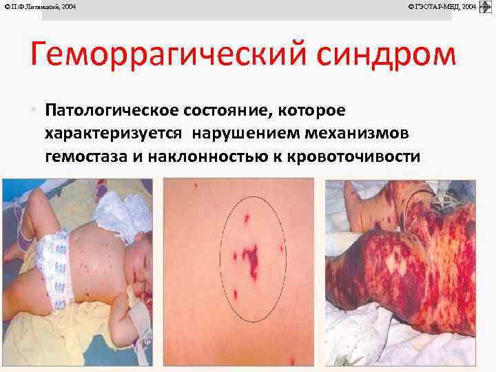 © П. Ф. Литвицкий, 2004 © ГЭОТАР-МЕД, 2004 Геморрагический синдром • Патологическое состояние, которое