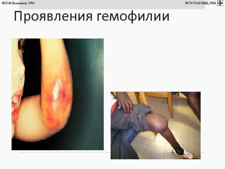 © П. Ф. Литвицкий, 2004 Проявления гемофилии © ГЭОТАР-МЕД, 2004 