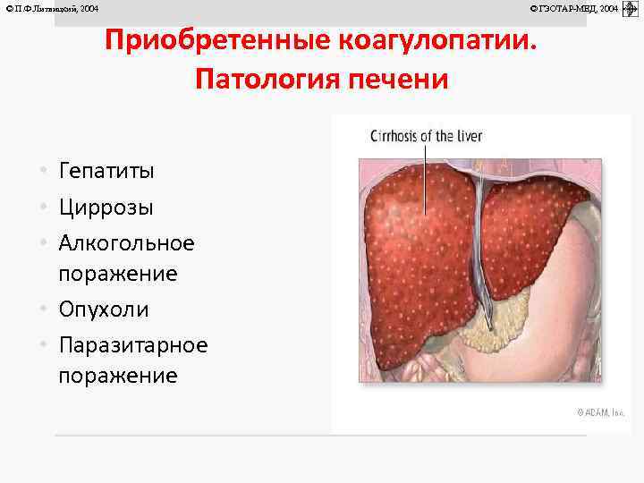 © П. Ф. Литвицкий, 2004 © ГЭОТАР-МЕД, 2004 Приобретенные коагулопатии. Патология печени • Гепатиты