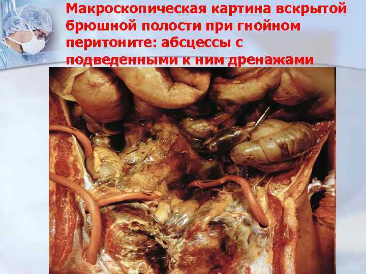 Макроскопическая картина вскрытой брюшной полости при гнойном перитоните: абсцессы с подведенными к ним дренажами