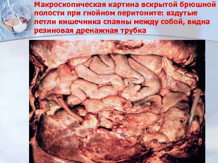 Макроскопическая картина вскрытой брюшной полости при гнойном перитоните: вздутые петли кишечника спаяны между собой,