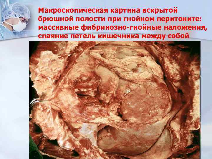 Макроскопическая картина вскрытой брюшной полости при гнойном перитоните: массивные фибринозно-гнойные наложения, спаяние петель кишечника