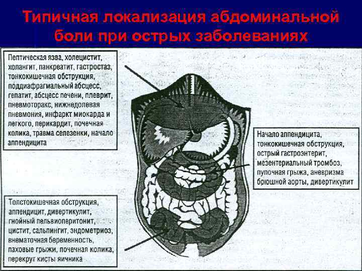 Типичная локализация абдоминальной боли при острых заболеваниях 