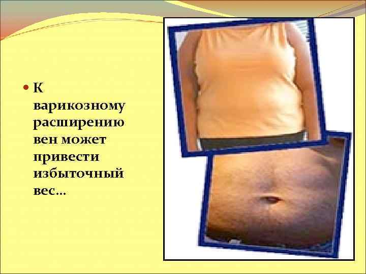  К варикозному расширению вен может привести избыточный вес… 
