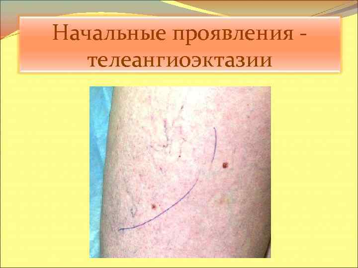 Начальные проявления - телеангиоэктазии 